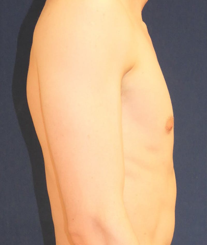 Pectoral Implants Before & After Gallery - Patient 274796 - Image 3