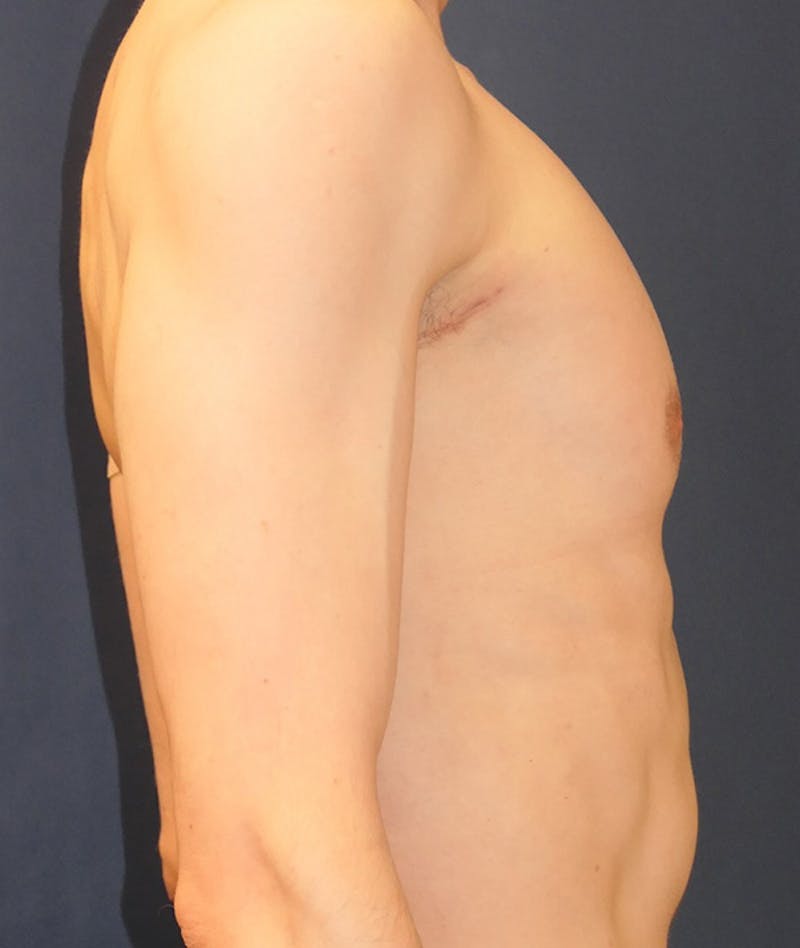 Pectoral Implants Before & After Gallery - Patient 274796 - Image 4