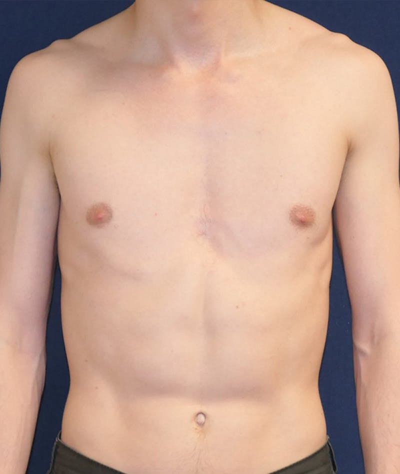 Pectoral Implants Before & After Gallery - Patient 274796 - Image 1