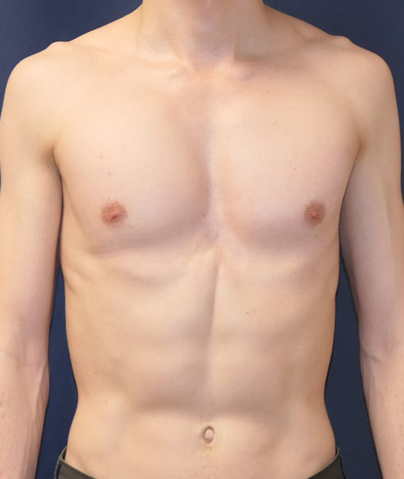 Pectoral Implants Before & After Gallery - Patient 274796 - Image 2