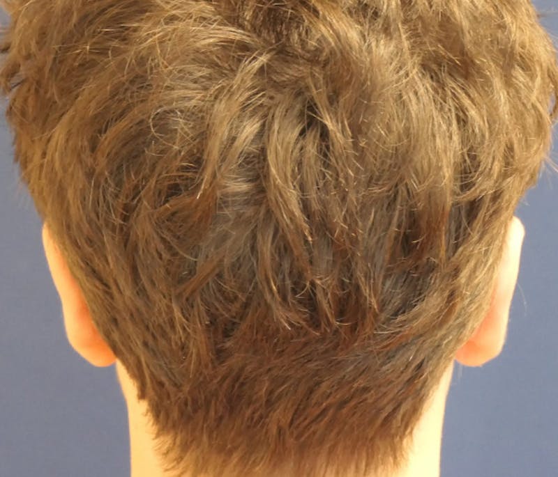 Ear Pinning (Otoplasty) Before & After Gallery - Patient 172191 - Image 8