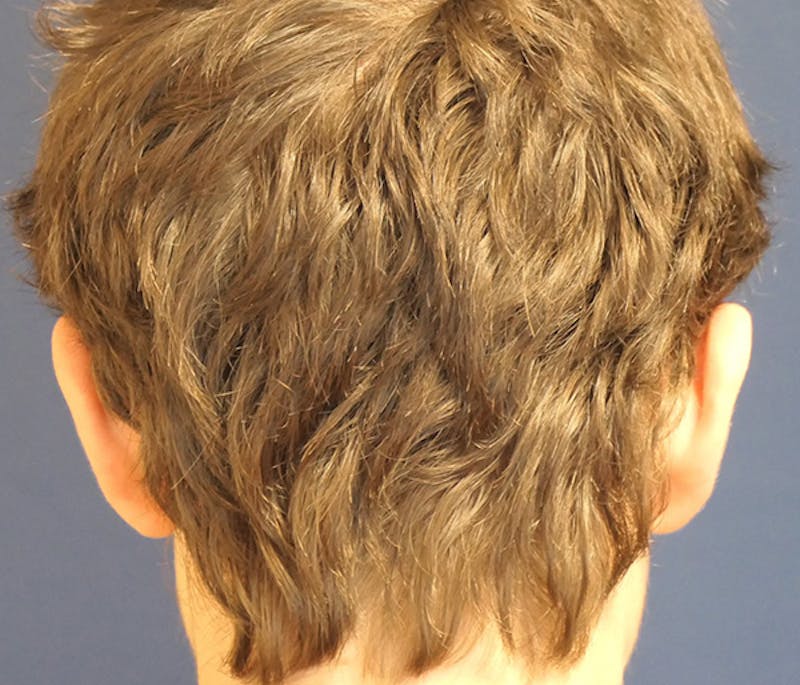 Ear Pinning (Otoplasty) Before & After Gallery - Patient 172191 - Image 7
