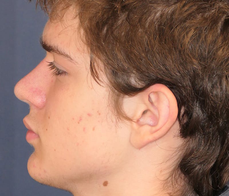 Ear Pinning (Otoplasty) Before & After Gallery - Patient 172191 - Image 5
