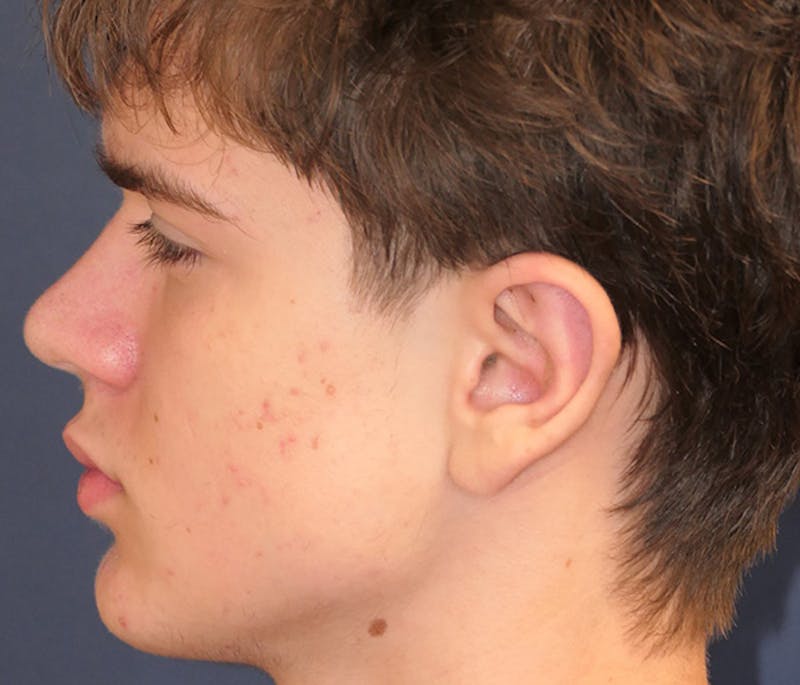 Ear Pinning (Otoplasty) Before & After Gallery - Patient 172191 - Image 6