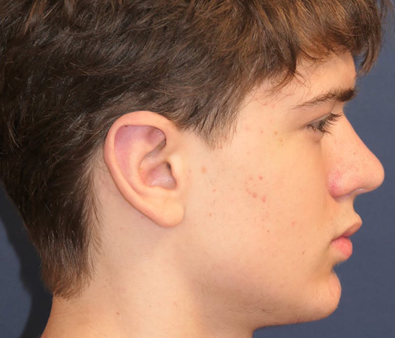 Ear Pinning (Otoplasty) Before & After Gallery - Patient 172191 - Image 4