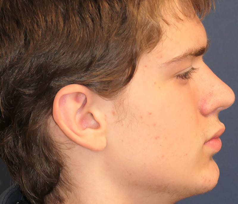 Ear Pinning (Otoplasty) Before & After Gallery - Patient 172191 - Image 3
