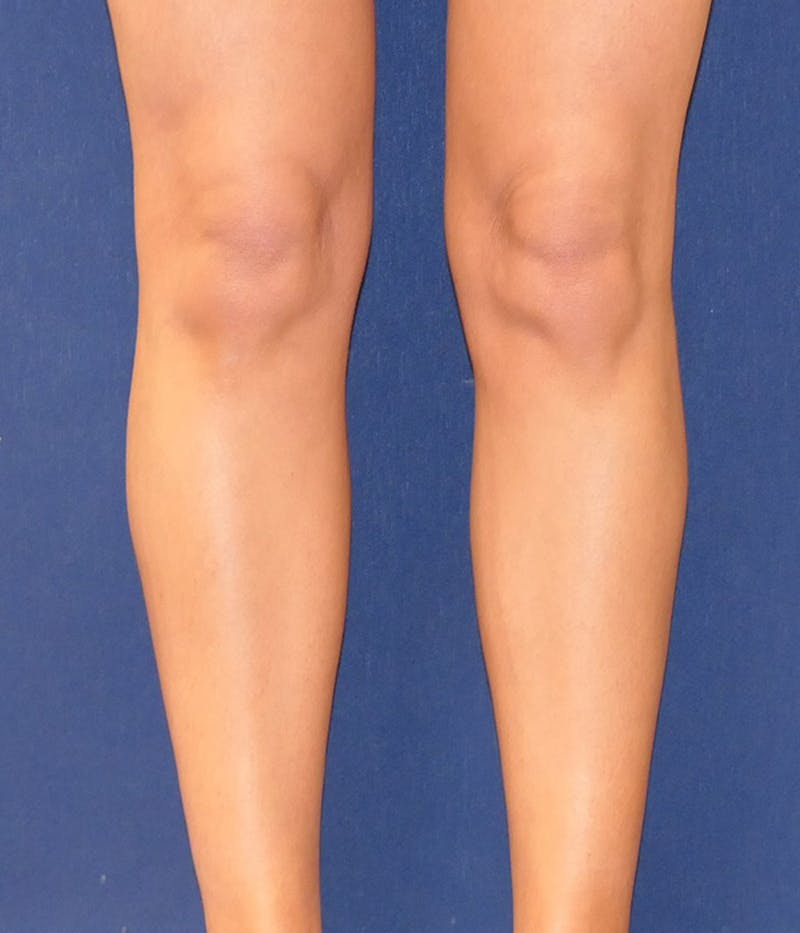 Calf Augmentation with Implants Before & After Gallery - Patient 228039 - Image 13