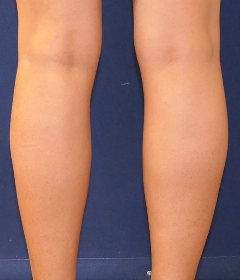Calf Augmentation with Implants Before & After Gallery - Patient 228039 - Image 3