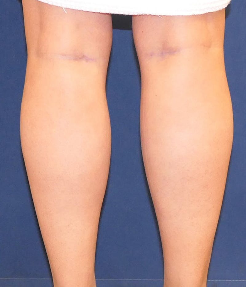 Calf Augmentation with Implants Before & After Gallery - Patient 228039 - Image 4