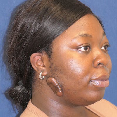 Miscellaneous Before & After Gallery - Patient 392028 - Image 1