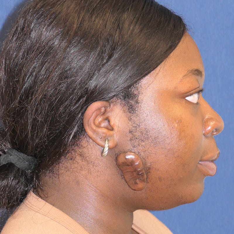 Miscellaneous Before & After Gallery - Patient 392028 - Image 3