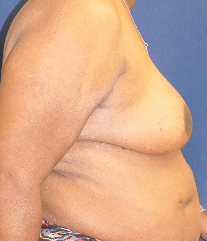 Breast Reconstruction with Implants Only Before & After Gallery - Patient 557936 - Image 6