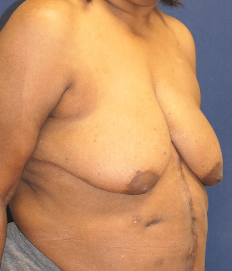 Breast Reconstruction with Implants Only Before & After Gallery - Patient 557936 - Image 3