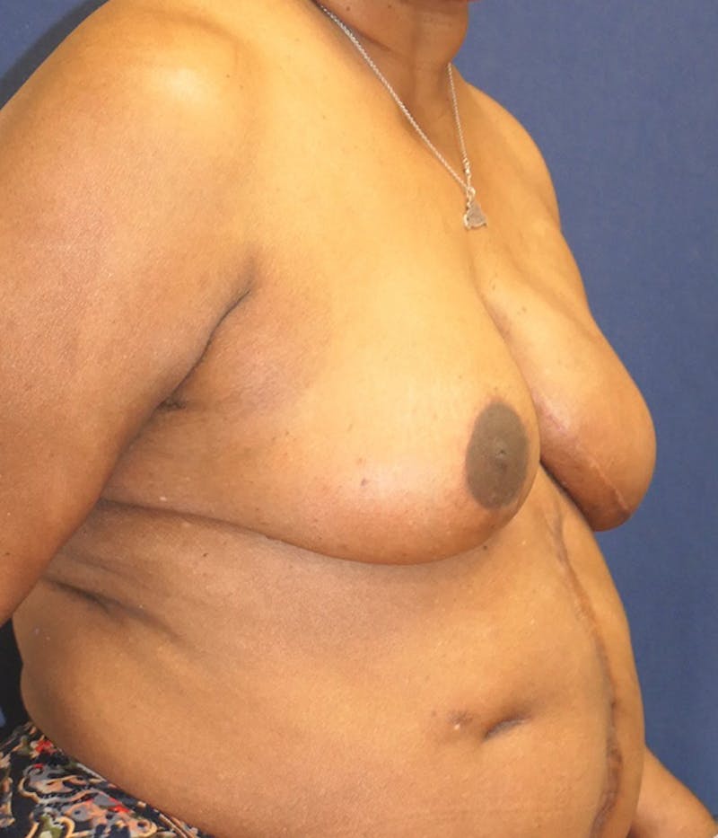 Breast Reconstruction with Implants Only Before & After Gallery - Patient 557936 - Image 4