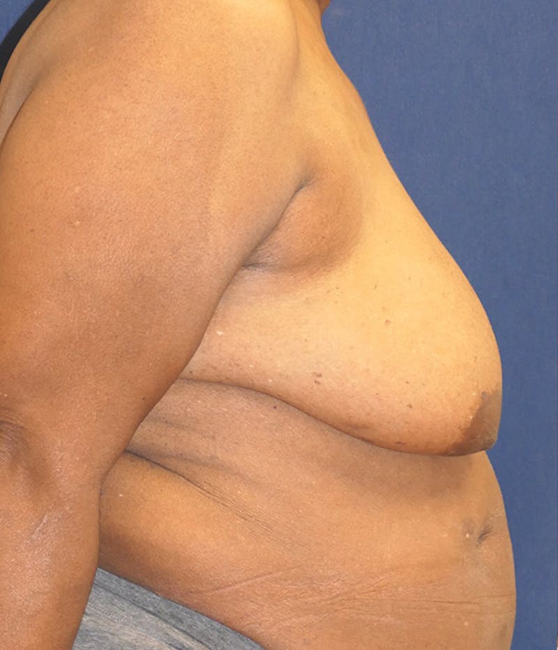 Breast Reconstruction with Implants Only Before & After Gallery - Patient 557936 - Image 5