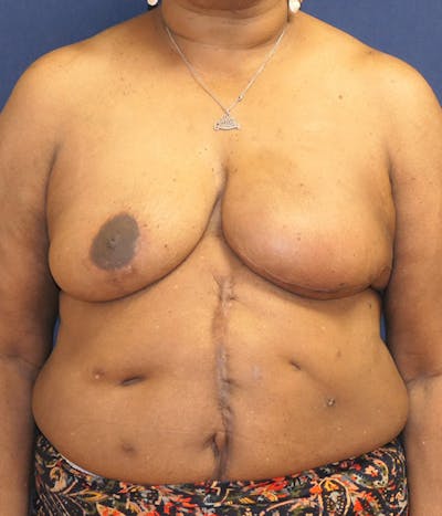 Breast Reconstruction with Implants Only Before & After Gallery - Patient 557936 - Image 2