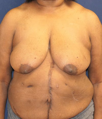 Breast Reconstruction with Implants Only Before & After Gallery - Patient 557936 - Image 1