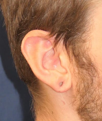 Miscellaneous Before & After Gallery - Patient 881344 - Image 1