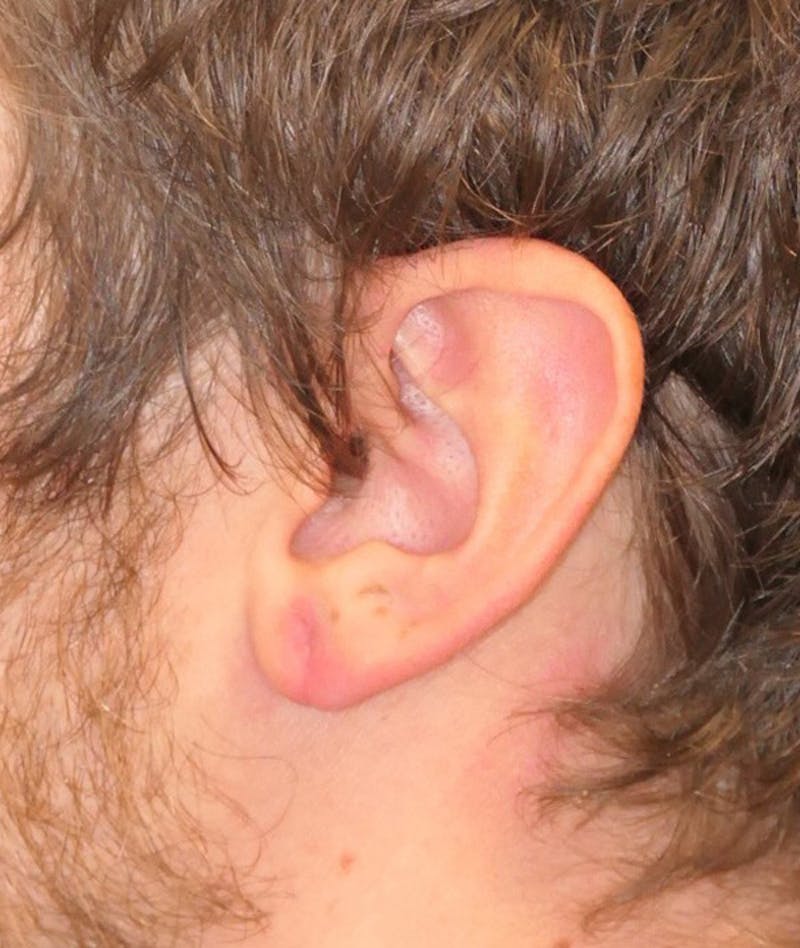 Miscellaneous Before & After Gallery - Patient 881344 - Image 4
