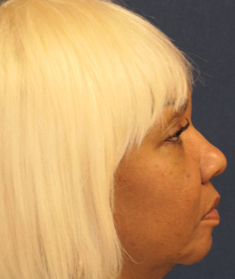 Eyelid Lift (Blepharoplasty) Before & After Gallery - Patient 451069 - Image 6