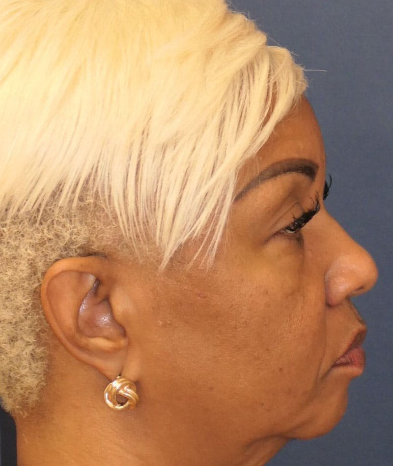Eyelid Lift (Blepharoplasty) Before & After Gallery - Patient 451069 - Image 5