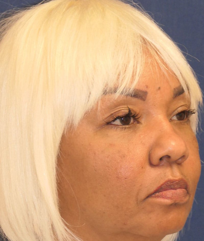 Eyelid Lift (Blepharoplasty) Before & After Gallery - Patient 451069 - Image 4