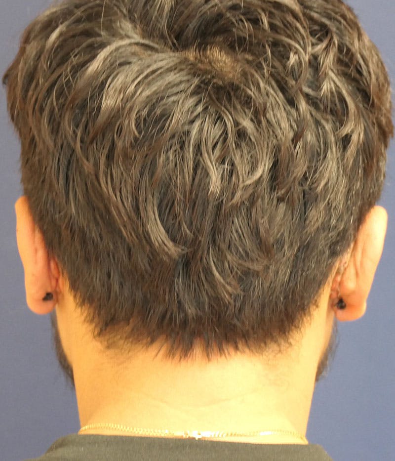 Ear Pinning (Otoplasty) Before & After Gallery - Patient 305898 - Image 8