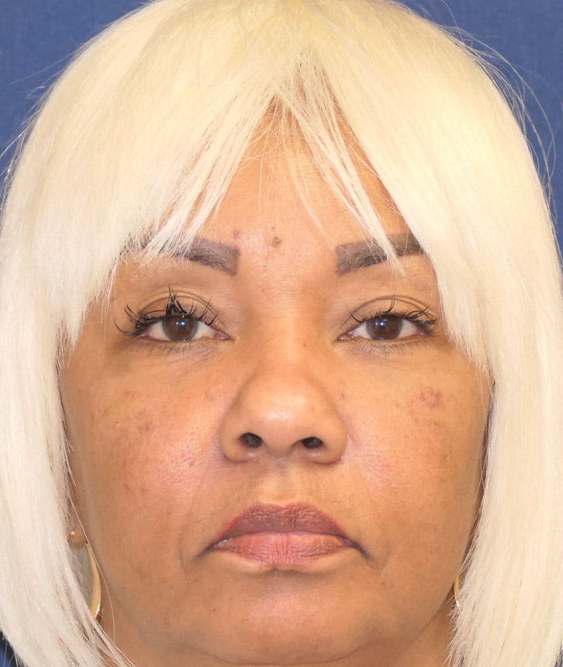 Eyelid Lift (Blepharoplasty) Before & After Gallery - Patient 451069 - Image 2