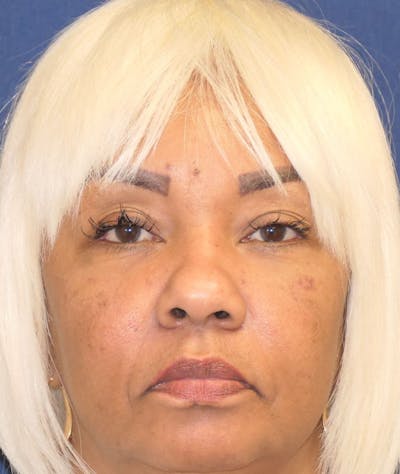 Eyelid Lift (Blepharoplasty) Before & After Gallery - Patient 451069 - Image 2