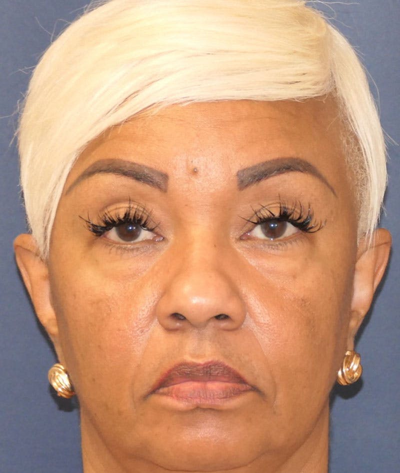 Eyelid Lift (Blepharoplasty) Before & After Gallery - Patient 451069 - Image 1