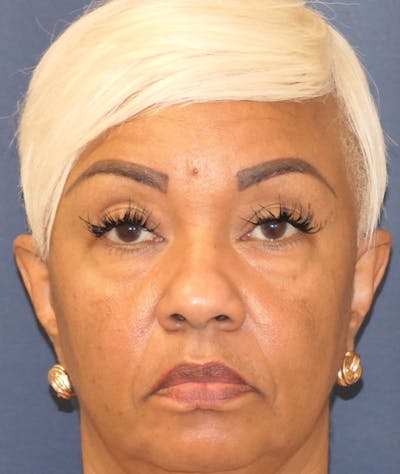 Eyelid Lift (Blepharoplasty) Before & After Gallery - Patient 451069 - Image 1