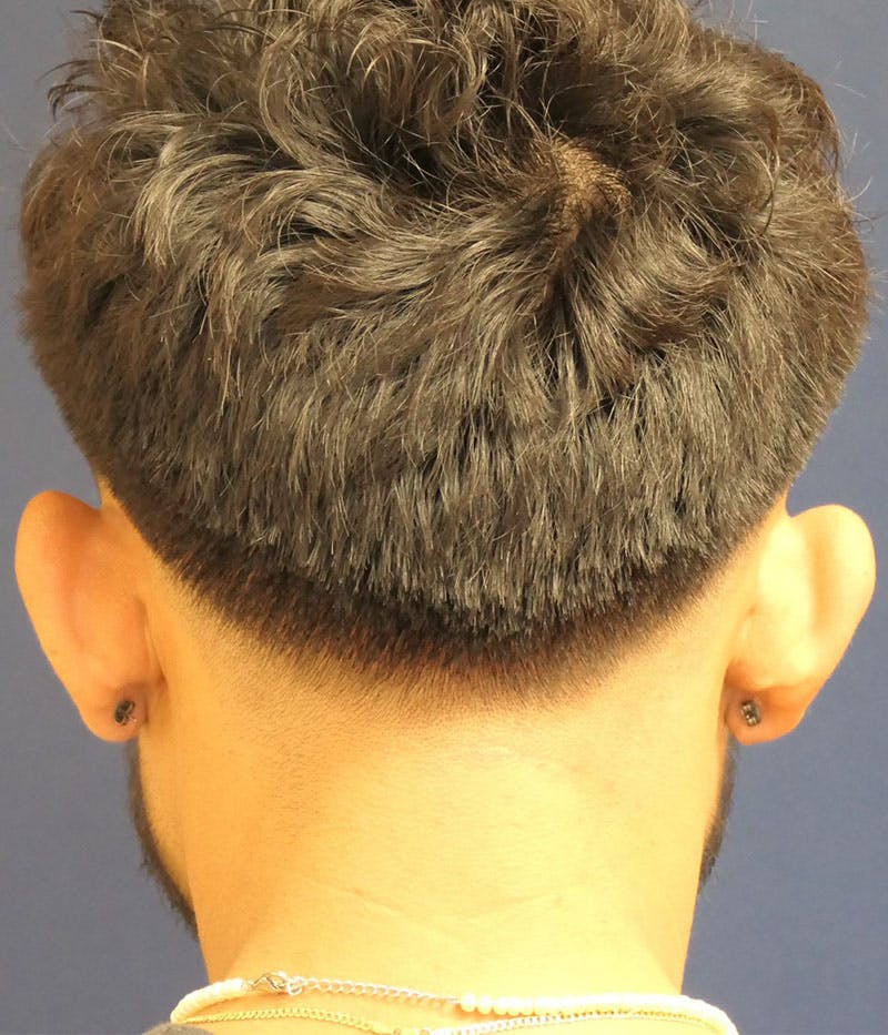 Ear Pinning (Otoplasty) Before & After Gallery - Patient 305898 - Image 7