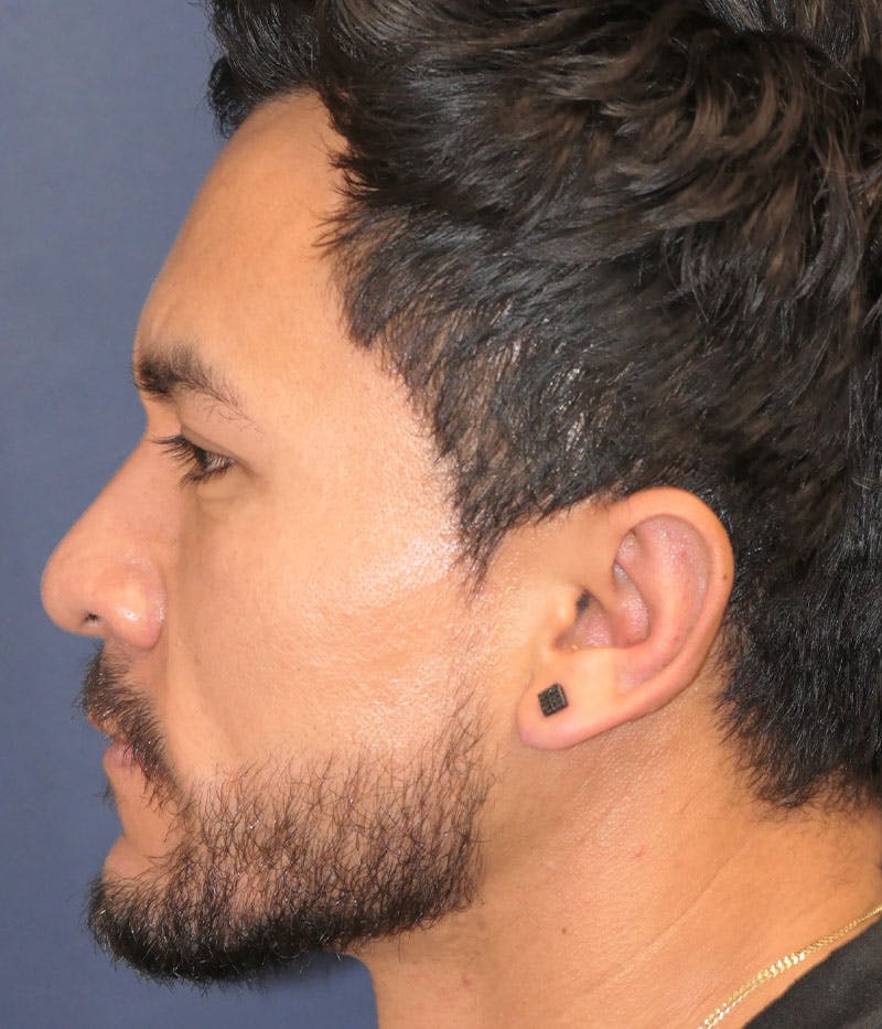 Ear Pinning (Otoplasty) Before & After Gallery - Patient 305898 - Image 6