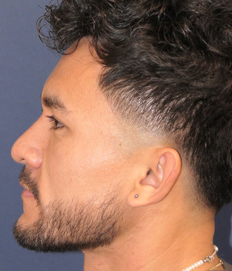 Ear Pinning (Otoplasty) Before & After Gallery - Patient 305898 - Image 5