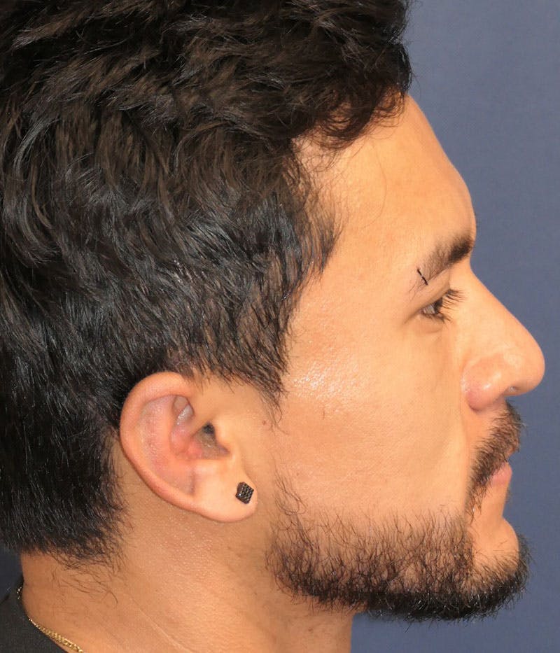 Ear Pinning (Otoplasty) Before & After Gallery - Patient 305898 - Image 4
