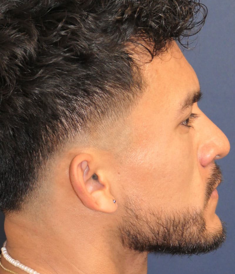 Ear Pinning (Otoplasty) Before & After Gallery - Patient 305898 - Image 3