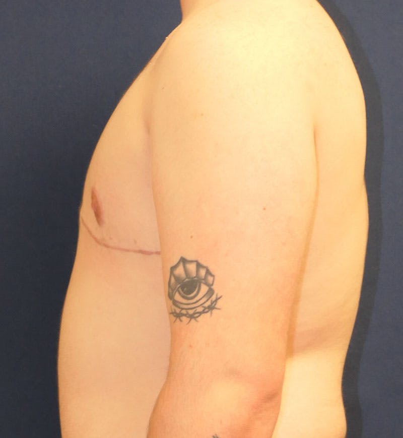 Masculinizing Surgery Before & After Gallery - Patient 224494 - Image 6