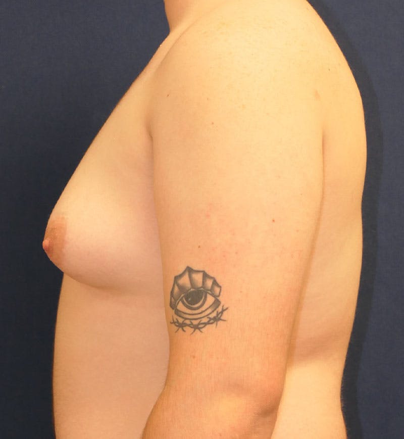 Masculinizing Surgery Before & After Gallery - Patient 224494 - Image 5