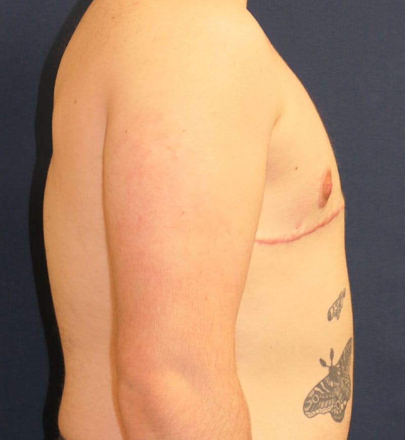 Masculinizing Surgery Before & After Gallery - Patient 224494 - Image 4