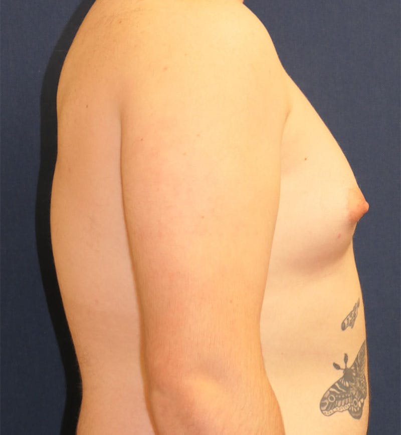 Masculinizing Surgery Before & After Gallery - Patient 224494 - Image 3