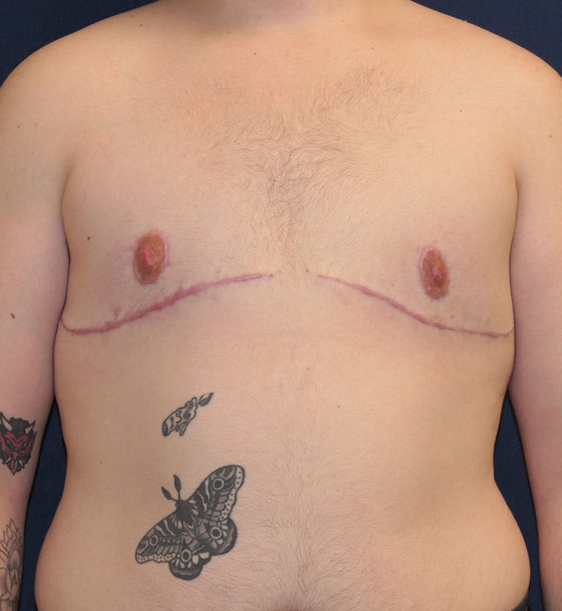 Masculinizing Surgery Before & After Gallery - Patient 224494 - Image 2