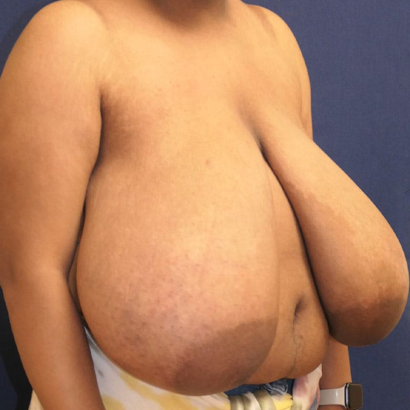 Breast Reduction Before & After Gallery - Patient 157865 - Image 5
