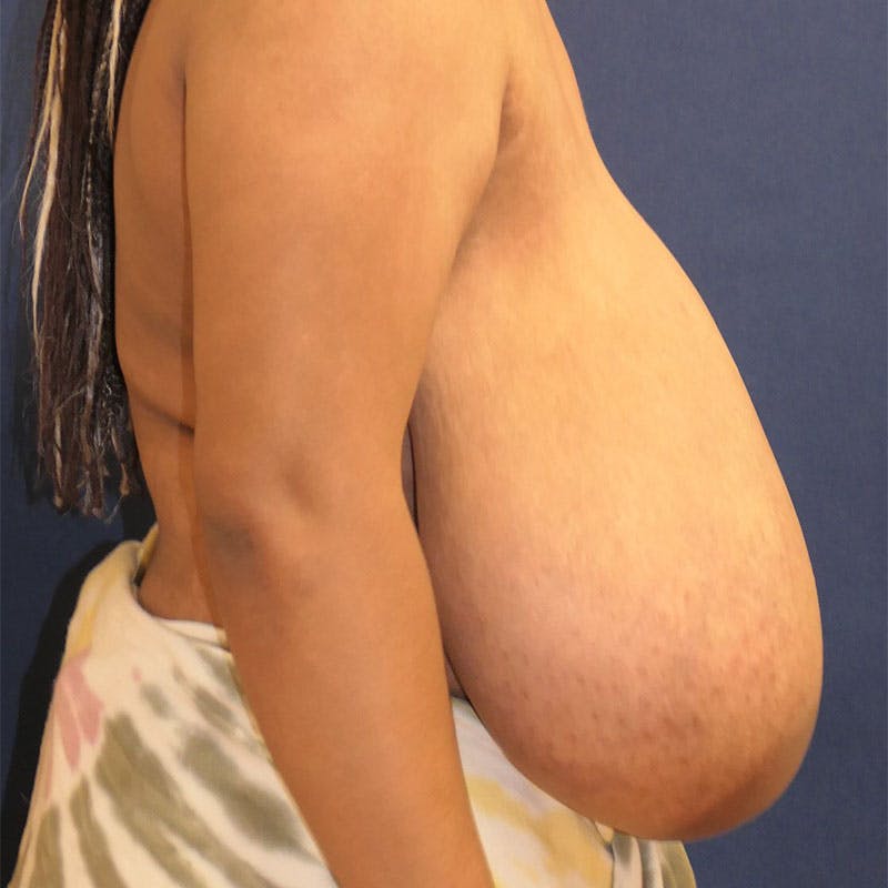 Breast Reduction Before & After Gallery - Patient 157865 - Image 3