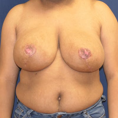 Breast Reduction Before & After Gallery - Patient 157865 - Image 2