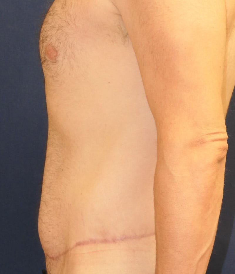 Tummy Tuck (Abdominoplasty) Before & After Gallery - Patient 594776 - Image 6
