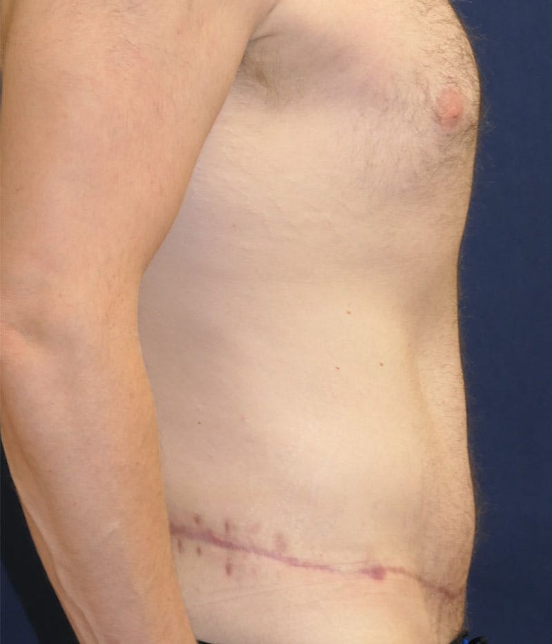 Tummy Tuck (Abdominoplasty) Before & After Gallery - Patient 594776 - Image 4