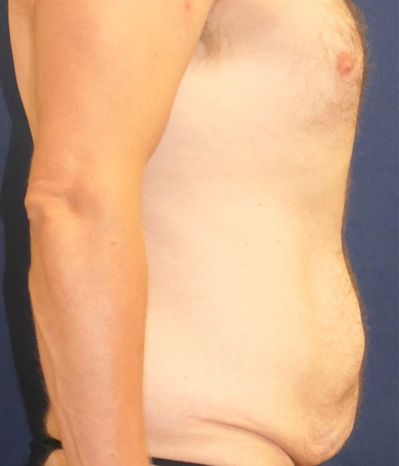 Tummy Tuck (Abdominoplasty) Before & After Gallery - Patient 594776 - Image 3