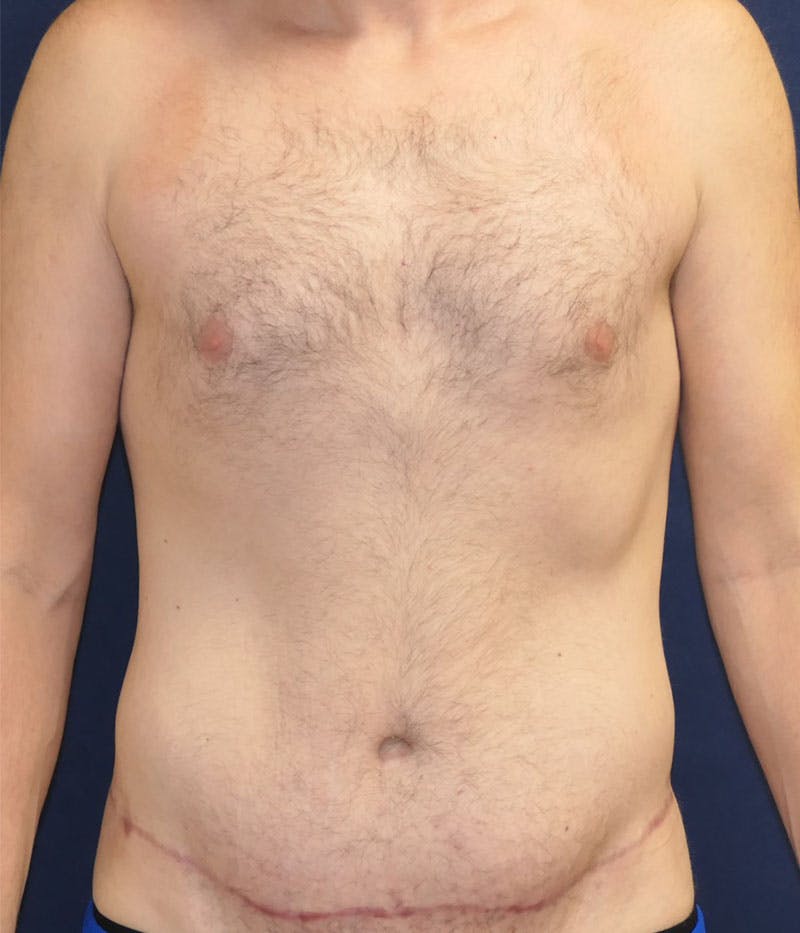 Tummy Tuck (Abdominoplasty) Before & After Gallery - Patient 594776 - Image 2