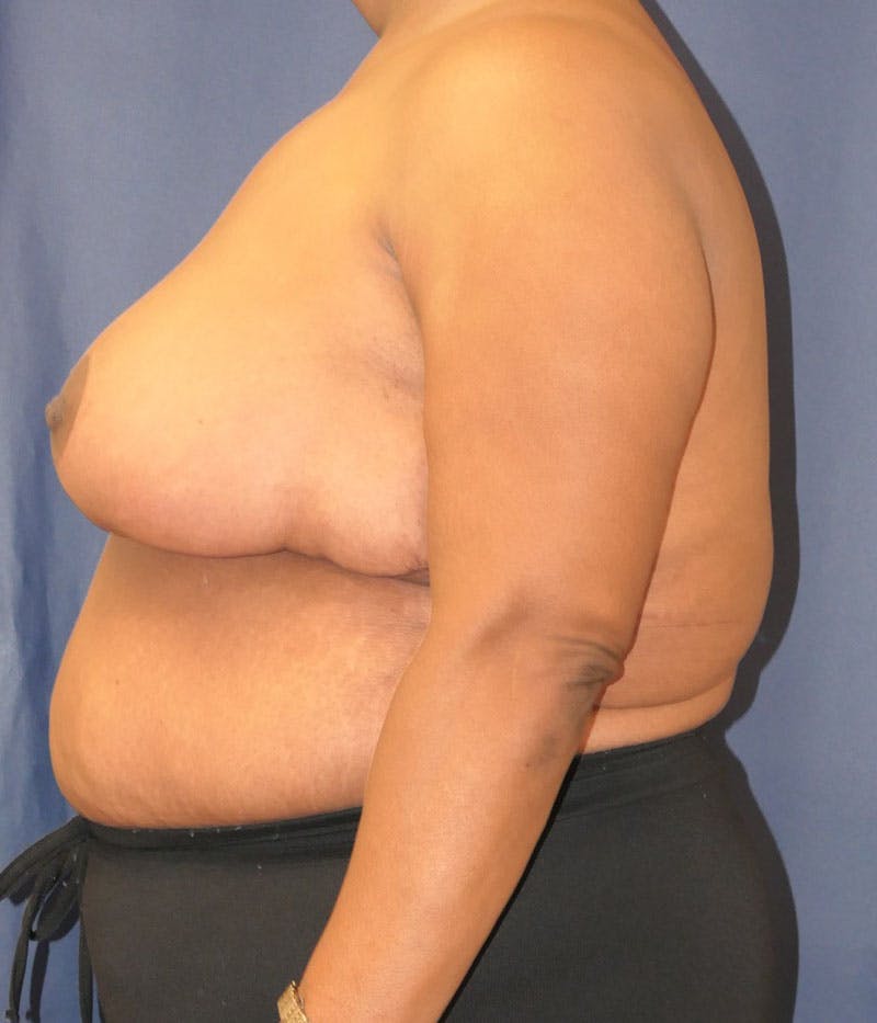 Breast Lift Before & After Gallery - Patient 387333 - Image 10
