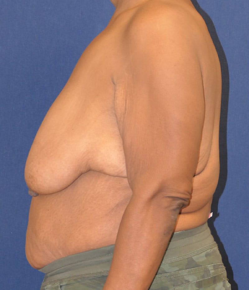 Breast Lift Before & After Gallery - Patient 387333 - Image 9